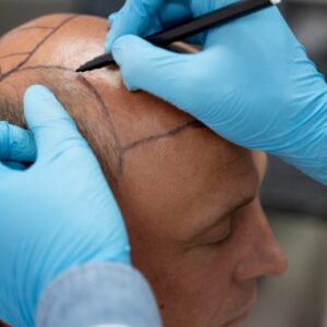 2026 Price Guide: What to Expect for Hair Transplant Cost UK