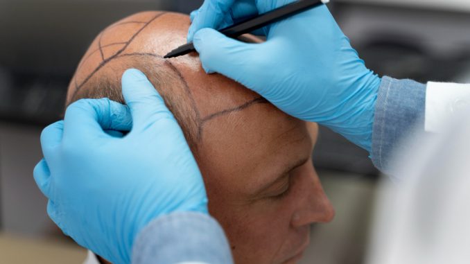 2026 Price Guide: What to Expect for Hair Transplant Cost UK